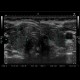 Hashitomo thyreoiditis: US - Ultrasound